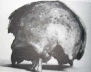 Čáslavská kalva s jasně viditelnou masivní deformací oblasti levé očnice. Foto: Archiv autora