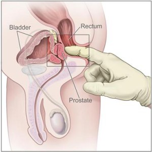 Mnoho mužů od vyšetření prostaty odrazuje způsob, kterým se provádí. Foto: Cancer.gov
