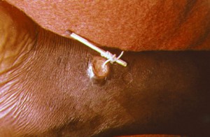 Vlasovec namotaný na sirce. Denně se touto bolestivou procedurou dají odstranit nejvýš jen dva centimetry červa. Foto: Wikipedia