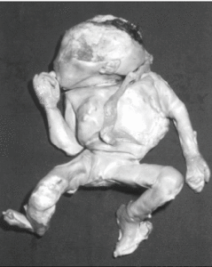 Tímto obrázkem kalcifikovaného abdominálního plodu doplnil svůj souhrnný článek z roku 2000 o lithopedionu tým brazilských lékařů.