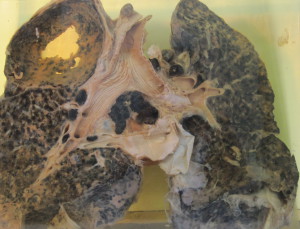 Plíce horníka postižené silikózou a tuberkulózou, taková kombinace už je dnes minulostí. Foto: Wikipedia