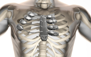 Takto vypadá implantát již připevněný v těle pacienta. Foto: Anatomics